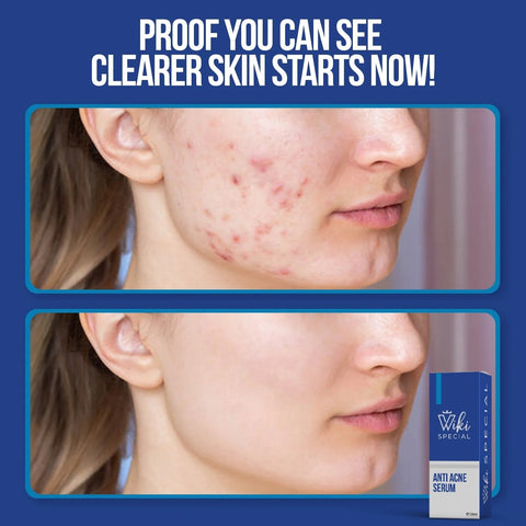 Special Anti-Acne Serum – Clears Pimples, Reduces Marks & Soothes Skin (30ml)