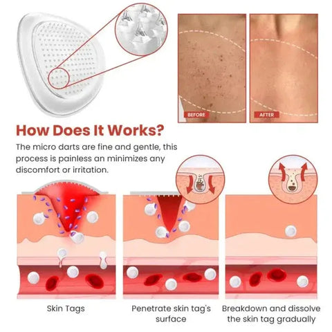 DermaSmooth Skin Tag Remover Patch Fast, Safe & Painless Removal with No Scars